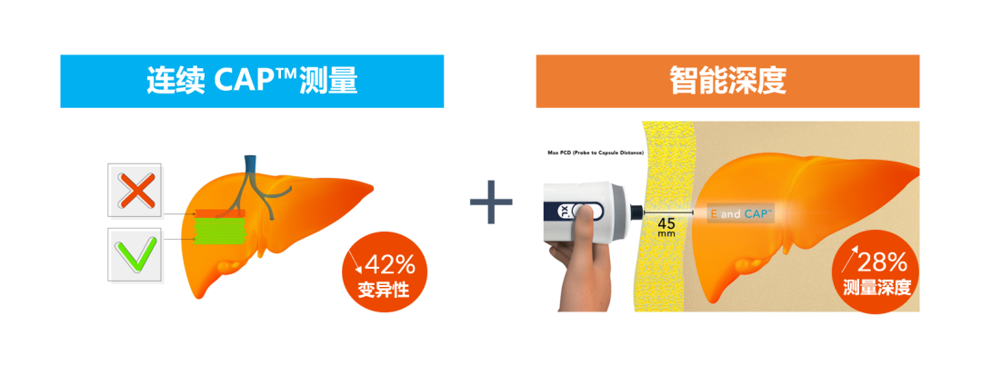 APASL2023 | SmartExam by FibroScan?在NAFLD中的應用優勢