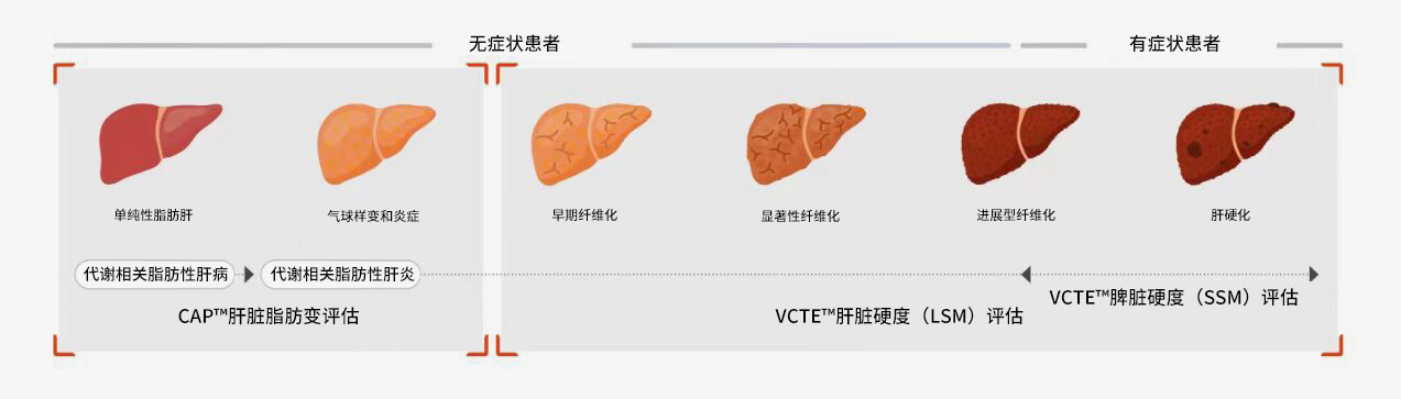 FibroScan? 檢查可為各種肝臟疾病的治療決策提供依據
